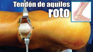 LESIONES del TENDÓN de AQUILES 🦶🏼 Causas Síntomas Tratamiento y Cirugía ⭐ Dr EDSON SERRANO Neomedica [upl. by Eiznyl]