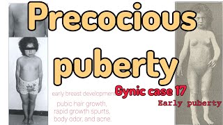 Precocious puberty gyniccase17 [upl. by Dugas]