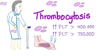 Thrombocytosis Primary and Secondary  Why Is My Platelet Count High  Hematology [upl. by Alejandro]