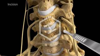 c5c6c7 Anterior Cervical Discectomy with Fusion [upl. by Choo159]