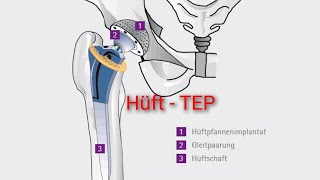 Was ist eine Hüft  TEP Ursache Diagnose und Therapie [upl. by Ecirtaed]