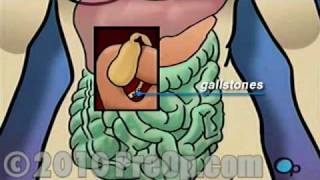 Gallbladder Removal Laparoscopic PreOp® Patient Education Feature [upl. by Cris421]