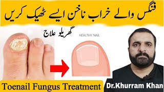 Toenail Fungus Treatment خراب ناخن کا علاج  DrKhurram RPh  toenailfungustreatment [upl. by Sirdi]