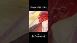 Myocardial Infarction Heart Attack Animated video 😯 [upl. by Esiuolyram]