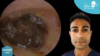 1221  Complete Ear Wax Blockage Removal [upl. by Ahsela]