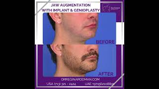 Jaw Augmentation w Implant [upl. by Wystand728]