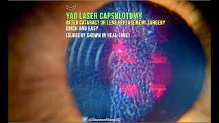 Everything you need to know about YAG LASER capsulotomy in 30 seconds [upl. by Gabel]