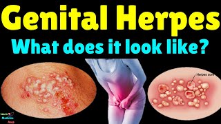 What Does Genital Herpes Look Like  Genital Herpes Signs and Symptoms Treatment and Complications [upl. by Zorana760]