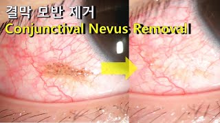 결막 모반 제거 Conjunctival nevus removal [upl. by Leandre]