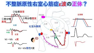 心電図：暗記からの卒業 108話 不整脈原性右室心筋症 [upl. by Notle516]