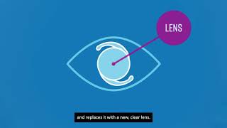 The PanOptix® Lens the first trifocal lens for cataract surgery [upl. by Aunson]