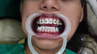 BRACES PUTTING ON TEETH TOOTH TIME FAMILY [upl. by Conlon]