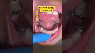 Bilateral Space Maintainer Orthodontics [upl. by Cohla]