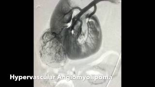 Renal Angiomyolipoma AML Transcatheter Ethanol Alcohol Embolization [upl. by Jet]