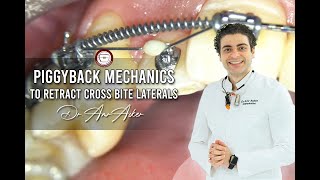 piggyback mechanics to retract cross bite laterals in orthodontics [upl. by Spohr]