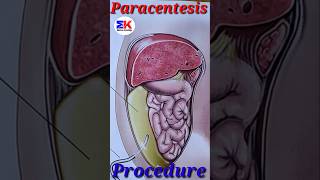 Paracentesis procedures medicineknowledgehindi short [upl. by Elna]