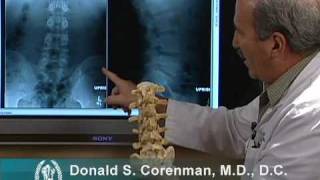 How to Read Xrays of the Lumbar Spine Lower Back  Spine Surgeon Colorado [upl. by Aratas292]