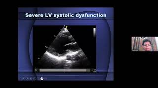 2024 08 09 20 10 55 Cardiomyopathies by Dr Hansa Gupta [upl. by Clardy]