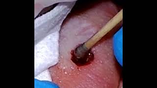 Punch Biopsy of Left Ventral Tongue for Leukoplakia [upl. by Lysander]