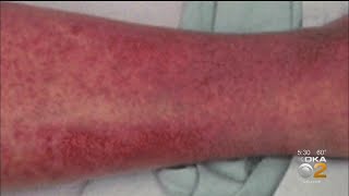 Why Does Coronavirus Cause Harmful Rashes [upl. by Nailuj]