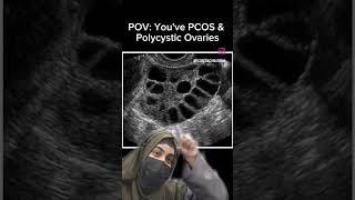 😀Polycystic Ovaries is a common symptom of PCOS Suxh ultrasound shows that you have PCOS pcos [upl. by Nnalatsyrc]