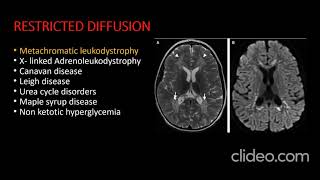 IMAGING APPROACH TO LEUKODYSTROPHIES [upl. by Entirb]