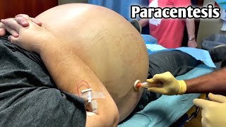 شاهد كيف يتم سحب السوائل من البطن الأستسقاء  Remove abdominal fluid ascites  Paracentesis [upl. by Anirtak]