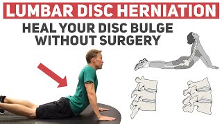 3 Core Exercises For Slipped Disc [upl. by Ursa772]