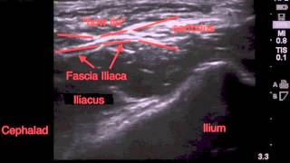 Ultrasound Guided Fascia Illiaca Block Tutorial  SSRAUSAcom [upl. by Knutson]