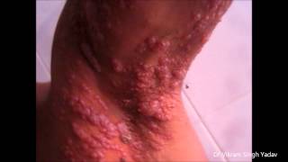 Classical Presentation Of Herpes Zoster amp Treatment [upl. by Nnagem]