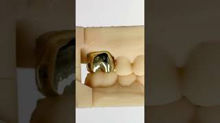 Double Gold Crowns EnvisiontecMain envisiontec lsk121shorts dentist teeth [upl. by Anaimad]