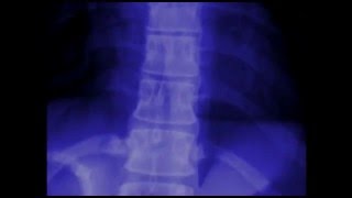 Areas of Inflammation in Ankylosing Spondylitis [upl. by Arised490]