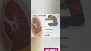 thoracentesis procedure health thoracentesis [upl. by Clementine]