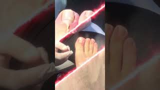 Studio podologie SOS ongle incarné 💥 ingrowntoenail nails pedicure [upl. by Leinahtan127]