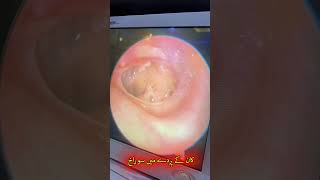 Perforated Eardrum Causes Symptoms and Effective Treatment [upl. by Nagyam]