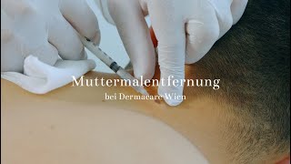 Muttermalentfernung bei Dermacare Wien [upl. by Adliwa]