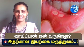 வாய்ப்புண் ஏன் வருகிறது அதற்கான இயற்கை மருத்துவம் Stomatitis Treatment  Tamil TV [upl. by Asina865]