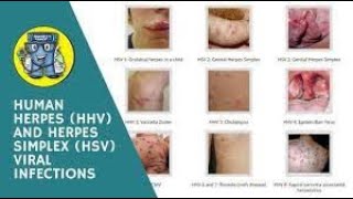 Human Herpes Virus infections I causes symptoms diagnosis treatment pathology [upl. by Annaya364]