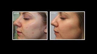 Laser acne treatment with BBL  Microlaser Peel [upl. by Oniotna]