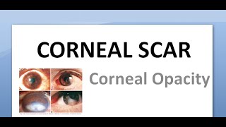 Ophthalmology 144 Acquired Corneal Scar Opacity Type Nebular Macular Leucoma Anterior Staphyloma [upl. by Orlantha986]