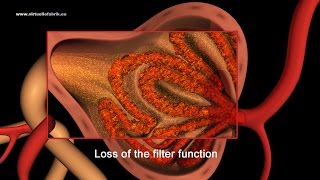 3D Animation Fokal segmental glomerulosklerose FSGS [upl. by Fachini740]