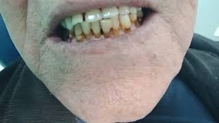 Vist 4 A single upper denture opposing lower natural teeth Avoid incisal guidance [upl. by Amik]