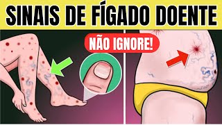 10 SINAIS de PROBLEMA no FÍGADO na PELE  Sintomas de GORDURA NO FÍGADO CIRROSE e HEPATITE [upl. by Gothurd]