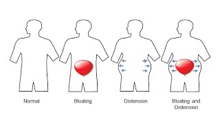 ACUPUNCTURE TREATMENT FOR ABDOMINAL DISTENTION BLOATING [upl. by Ducan]