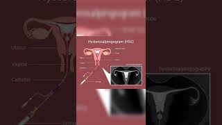 Hysterosalpingography  Salpingitis  Fallopian tube blockage  Nodular diverticulaeInfertility [upl. by Jo-Anne209]