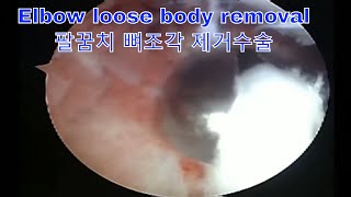 Arthroscopic Removal of Osteochondritis Dissecans Loose Body in the Elbow 팔꿈치 관절에서 뼈조각 제거를 위한 관절경 수술 [upl. by Ellekcim]