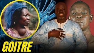 Goitre 1   Causes et Conséquences   Pr Ousmane Ndiaye  SAMA XALAAT TV [upl. by Viens]