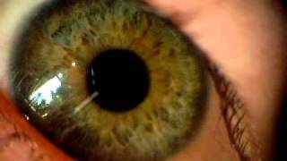 Eyeball dilation up close 2 [upl. by Nythsa]