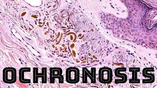 Ochronosis dark skin pigmentation caused by hydroquinone skin lightening cream or alkaptonuria [upl. by Grinnell]