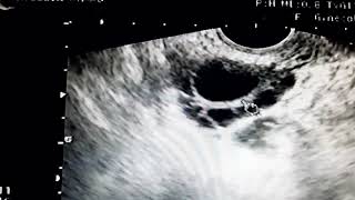 Folliculometry  Secondary infertility [upl. by Allisan627]